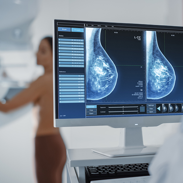MASTOGRAFIA